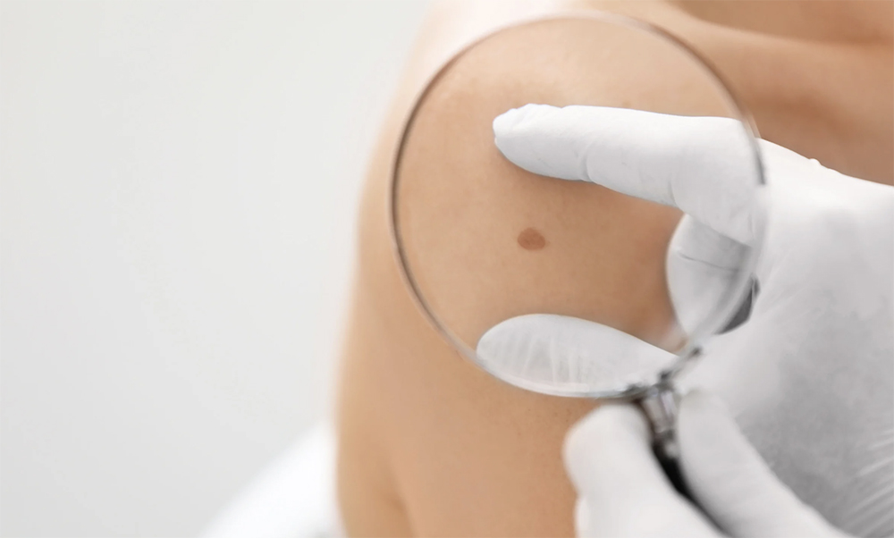 May is Skin Cancer Awareness Month